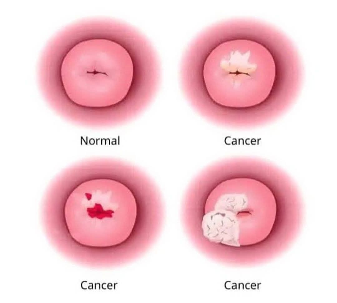 জরায়ুর টিকা HPV এবং HPV টেস্ট